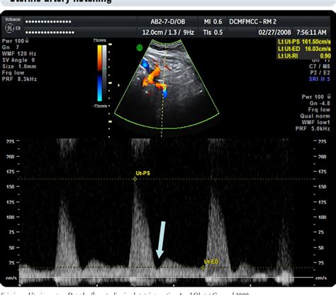 Uterine artery Doppler flow studies in obstetric practice